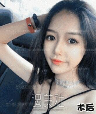 周珃小翘鼻案例展示，看她是如何逆天的!
