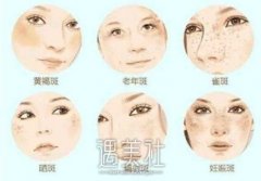 c6激光祛斑多少钱?影响价格的因素到底有哪些? width=