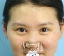 戴传昌做鼻子的果图分享，看她如何逆袭! width=