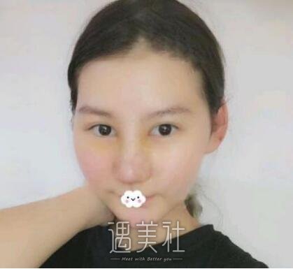 戴传昌做鼻子的果图分享，看她如何逆袭!