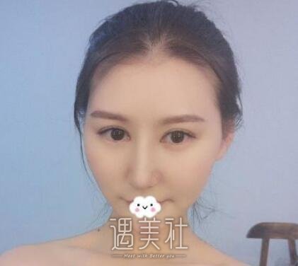 戴传昌做鼻子的果图分享，看她如何逆袭!
