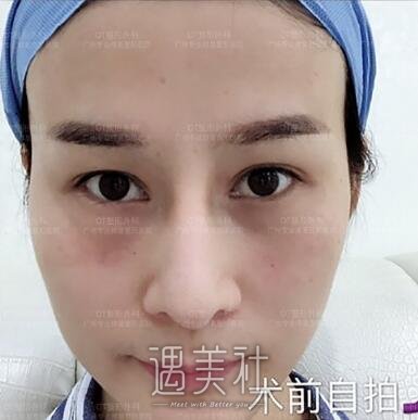 谭文立医生技术好吗?脂肪填充真实案例分享一波~