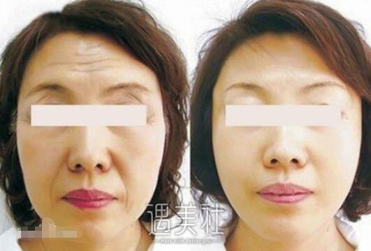 像素射频除皱做一次就可以了吗?果能保持多久?