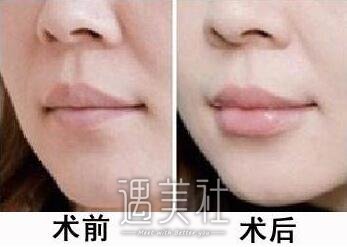 自提脂肪填充后忌讳的是什么?怎么样才能变成小仙女!