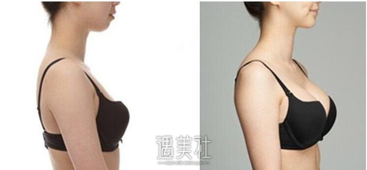自提脂肪填充后忌讳的是什么?怎么样才能变成小仙女!