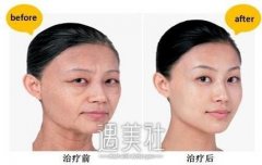 伊凡露注射除皱果怎么样?一针抚平岁月痕迹 width=