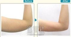 抽脂胳膊手术多少钱?彻底摆脱拜拜肉和蝴蝶袖~ width=