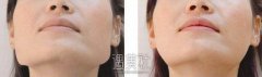 磨骨手术会引致的危害和后遗症都是什么? width=