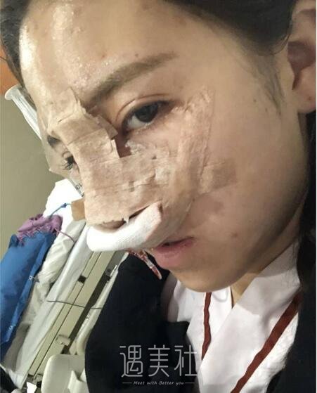 常德凯尔美斯冯涛做双眼皮隆鼻如何，案例告诉你！