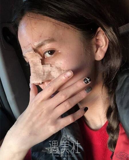 常德凯尔美斯冯涛做双眼皮隆鼻如何，案例告诉你！