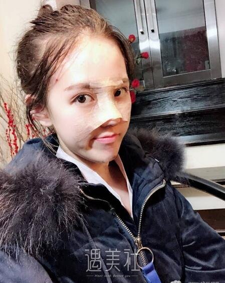 常德凯尔美斯冯涛做双眼皮隆鼻如何，案例告诉你！