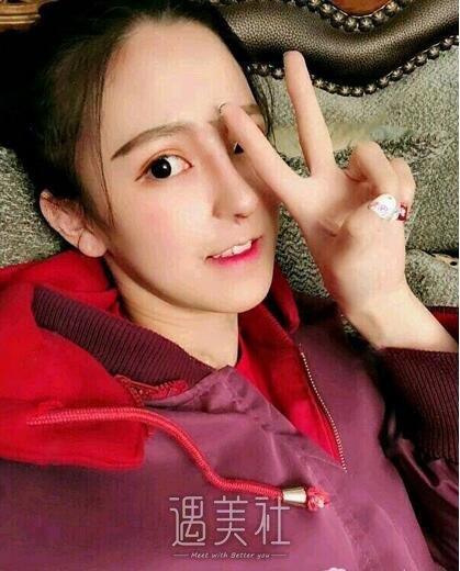 常德凯尔美斯冯涛做双眼皮隆鼻如何，案例告诉你！