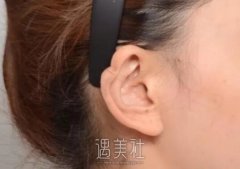 耳软骨隆鼻后竟出现耳轮凹陷疤痕增生！普罗菲耳可以修复吗？ width=