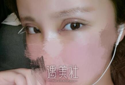 安贞医院整形李斌斌眼部手术案例