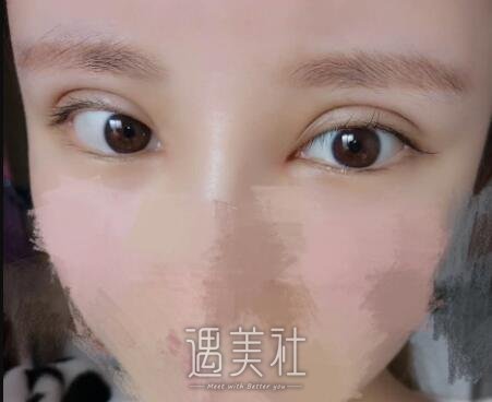 安贞医院整形李斌斌眼部手术案例