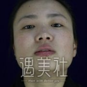 磨腮削骨恢复期到底有多长?亲身案例为你展示~ width=