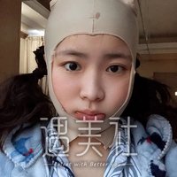 磨腮削骨恢复期到底有多长?亲身案例为你展示~