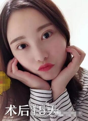 胡琼华博士双眼皮案例分享，甩掉单眼皮就这么简单!