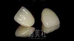 烤瓷牙寿命有限，究竟能使用多久呢? width=