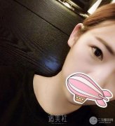 安贞医院李文志医生怎么样？双眼皮案例硬核证明实力！ width=