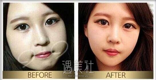 面部吸脂和去颊脂垫哪个好?傻傻的分不清!