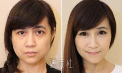 光乳化去眼袋多少钱?我想尽快将其处理掉! width=