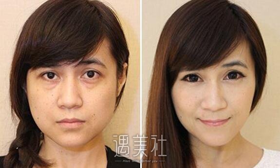 光乳化去眼袋多少钱?我想尽快将其处理掉!
