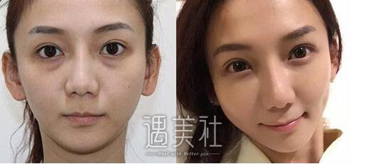 光乳化去眼袋多少钱?我想尽快将其处理掉!