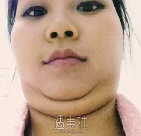 抽脂形体改良怎么做?步骤都有哪些?