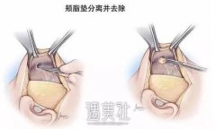 去颊脂垫恢复时间到底有多长，肌肉脸变小V脸~ width=