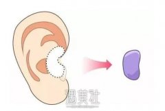 软骨隆鼻有什么危害，该如何避免? width=