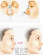 瑞兰2号注射下巴一次多少钱？ width=