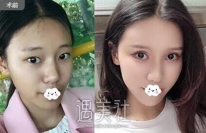 上海高分子双眼皮大概多少钱?哪些因素影响价格喃?