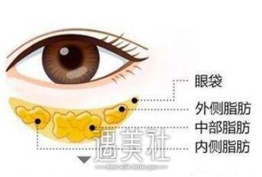 吸脂去眼袋有副作用吗?整理下吸脂去眼袋的副作用~