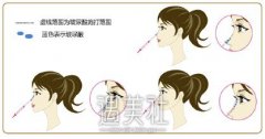 注射隆鼻的原料有哪些?注射隆鼻的原料哪个好? width=