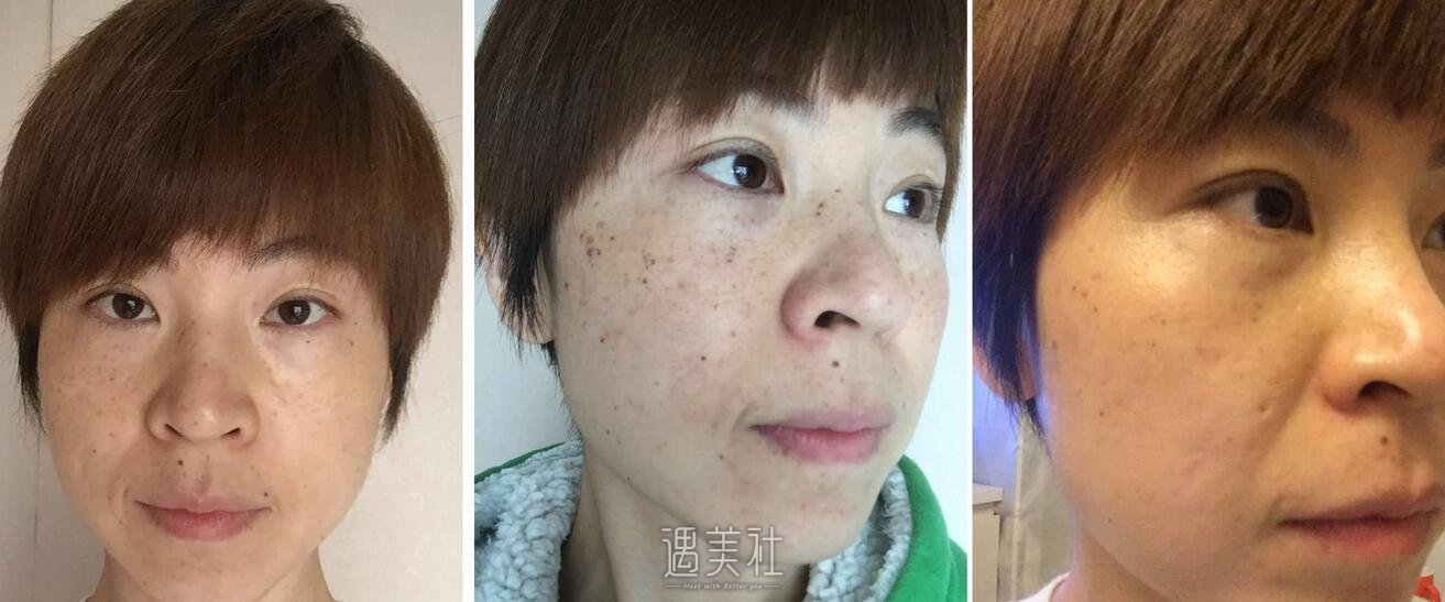 oe光子嫩肤价格