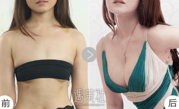 奥美定取出价格