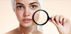 医院做蓝光祛痘多少钱?公立私立收费差异大吗? width=