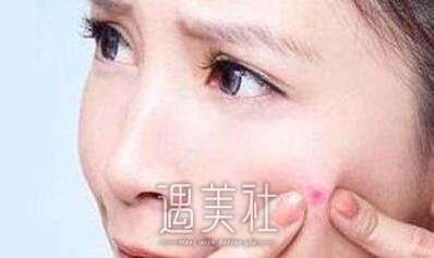 医院做蓝光祛痘多少钱?公立私立收费差异大吗?