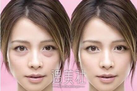 吸脂去眼袋有副作用吗?整理下吸脂去眼袋的副作用~