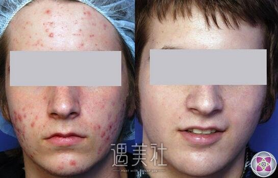 黑脸娃娃可以去痘印吗?黑脸娃娃去痘印靠谱吗?