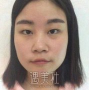 开外眼角前后对比图，开外眼角案例硬核展示果~ width=