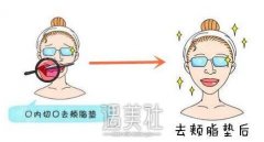去颊脂垫果怎么样？去颊脂垫真实案例力证~ width=