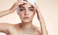 激光磨皮去痘印多久见，又能维持多久呢？ width=