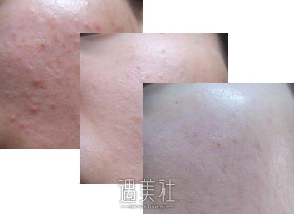 复合彩光去痘