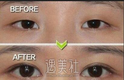 武汉亚太整形,双眼皮靠谱吗,收费合理吗