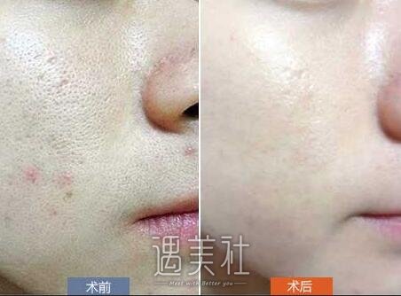 光子嫩肤,能祛痘印吗,优势大盘点