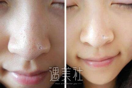 草莓鼻,调节方法,哪个好