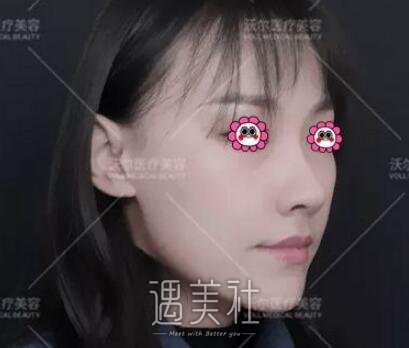 刘彦军鼻子案例有吗?听说刘彦君很擅长做隆鼻呢~