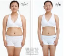 激光溶脂减肥对人体有没危害|激光溶脂减肥优缺点~ width=